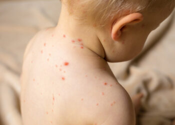 OBSH: Fruthi po përhapet në 58 shtete, rrezik nga rënia e vaksinimit