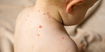 OBSH: Fruthi po përhapet në 58 shtete, rrezik nga rënia e vaksinimit