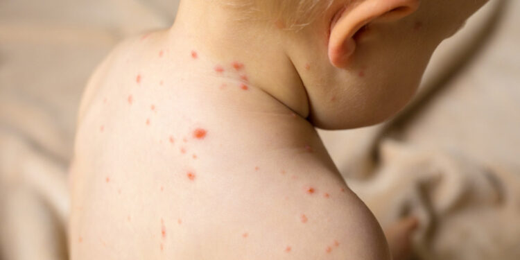 OBSH: Fruthi po përhapet në 58 shtete, rrezik nga rënia e vaksinimit