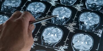 Barnat kundër kancerit hapin rrugë për trajtimin e Alzheimerit