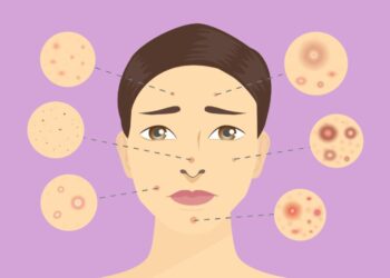 Aknet në të 50-at: 7 ushqime që mund të përkeqësojnë gjendjen e lëkurës, sipas dermatologëve