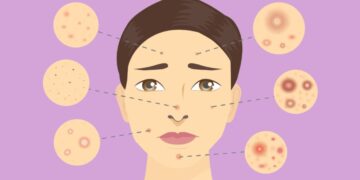 Aknet në të 50-at: 7 ushqime që mund të përkeqësojnë gjendjen e lëkurës, sipas dermatologëve