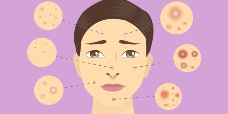 Aknet në të 50-at: 7 ushqime që mund të përkeqësojnë gjendjen e lëkurës, sipas dermatologëve