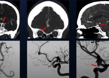 Presioni i parregulluar i gjakut – një nga shkaqet kryesore të shpërthimit të aneurizmave në tru