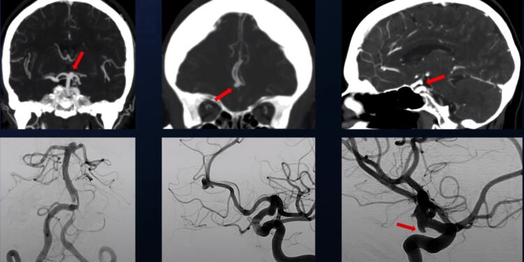 Presioni i parregulluar i gjakut – një nga shkaqet kryesore të shpërthimit të aneurizmave në tru