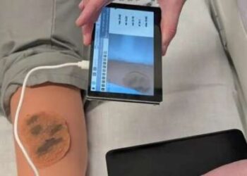 Inteligjenca Artificiale jep diagnozë të hershme për kancerin e lëkurës në zona të izoluara