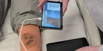 Inteligjenca Artificiale jep diagnozë të hershme për kancerin e lëkurës në zona të izoluara
