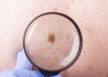 Kanceri i lëkurës: A është edhe HPV një shkak i mundshëm?