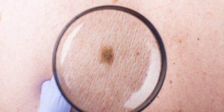 Kanceri i lëkurës: A është edhe HPV një shkak i mundshëm?