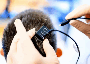 Implanti i trurit me inteligjencë artificiale rikthen të folurit pas 18 vitesh te një paciente e paralizuar