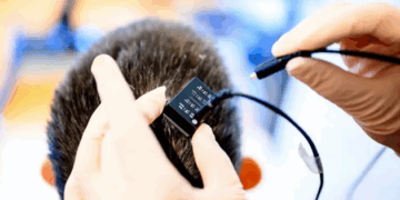 Implanti i trurit me inteligjencë artificiale rikthen të folurit pas 18 vitesh te një paciente e paralizuar