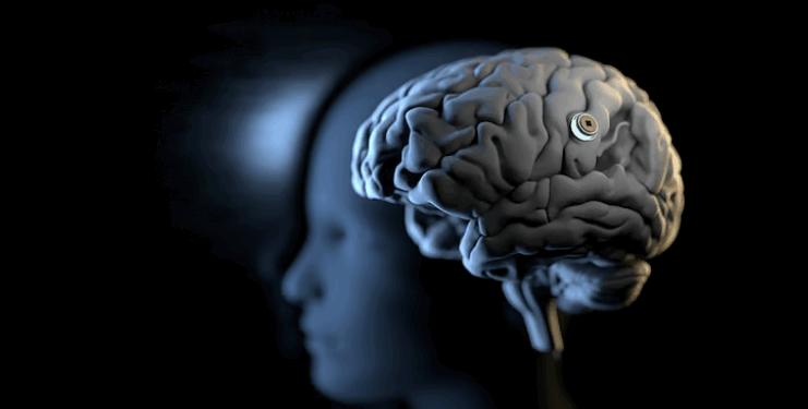 Implanti i ri në tru mund t’i lejojë njerëzit të flasin vetëm duke i imagjinuar fjalët