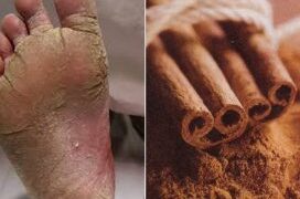 Thuajini Lamtumirë Këmbës së Atletit me Sherbelë, Kanellë dhe Bimë të Tjera