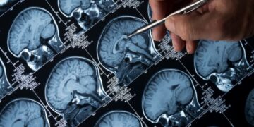 Studim: Doza të vogla litiumi mund të mbrojnë trurin nga Alzheimeri