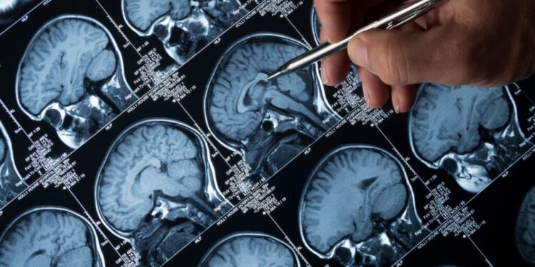 Studim: Doza të vogla litiumi mund të mbrojnë trurin nga Alzheimeri