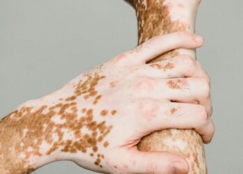 Trajtimet bimore për lëkurën: Akne, psoriaza dhe ekzema