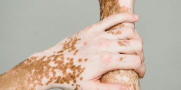 Trajtimet bimore për lëkurën: Akne, psoriaza dhe ekzema