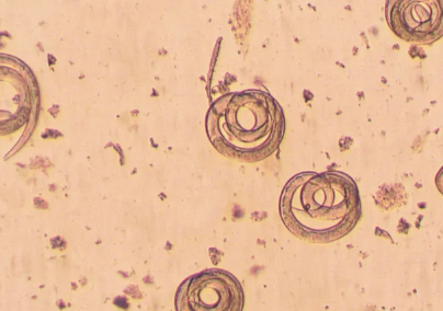 Ilaç natyral për parazitët në trup: si t’i dalloni shenjat dhe ta pastroni organizmin në mënyrë natyrale