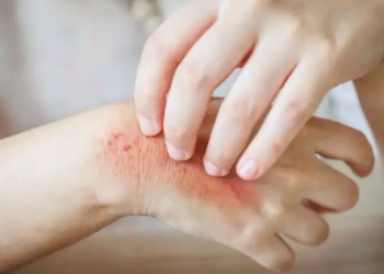 Ekzema, një nga sëmundjet më të shpeshta të lëkurës: shkaqet, llojet dhe trajtimet natyrale