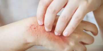 Ekzema, një nga sëmundjet më të shpeshta të lëkurës: shkaqet, llojet dhe trajtimet natyrale