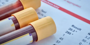 Si ta përmirësoni pasqyrën e gjakut në mënyrë natyrale – recetat dhe këshillat më efektive