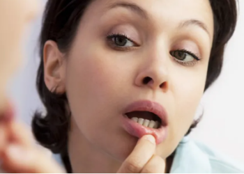 Inflamacioni i Mukozës Orale: Shkaqet, simptomat dhe kurat natyrale që ndihmojnë