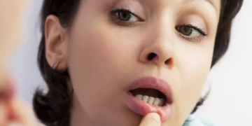 Inflamacioni i Mukozës Orale: Shkaqet, simptomat dhe kurat natyrale që ndihmojnë