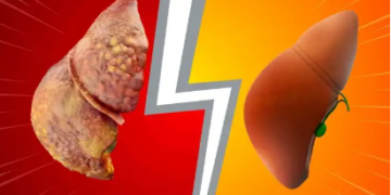 Detoksifikimi i mëlçisë: Pse bëhet dhe receta natyrale që ndihmon organizmin