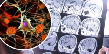 Shkencëtarët zbulojnë sa hapa në ditë mund ta ulin rrezikun e demencës deri në 51%