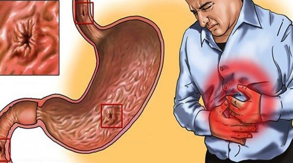 Gastriti dhe dhimbjet e stomakut: A mund të ndihmojnë majdanozi dhe uji i orizit? Çfarë duhet të dini